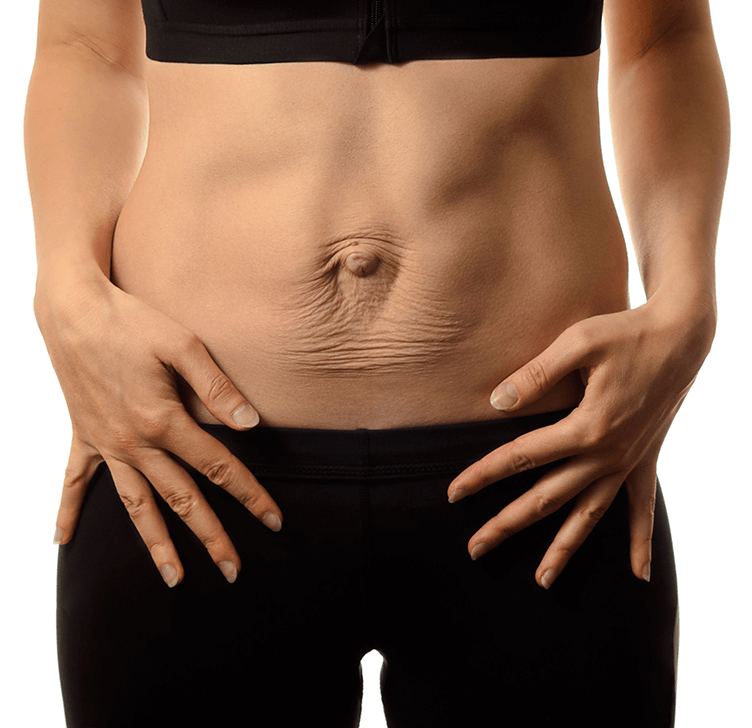 How to get rid of mommy pooch? – M&G Aesthetics Body Sculpting Wellness