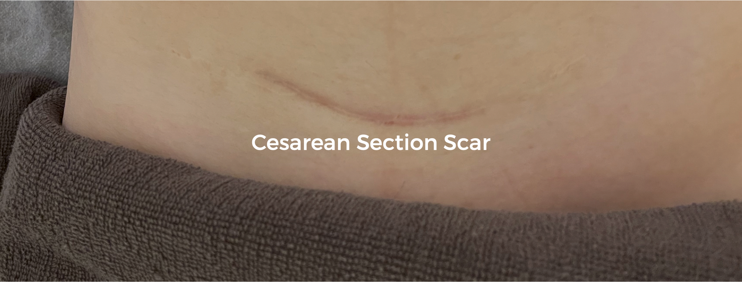 Cesarean C-Section Scar Removal Singapore - Edwin Lim Medical Aesthetic  Clinic